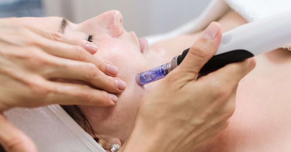 Practitioner performing a microneedling treatment on a woman